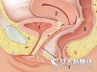 女避孕套使用方法(真人演示图)(7)(点击浏览下一张趣图)