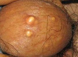 女性阴囊湿疹图片(2)(点击浏览下一张趣图)