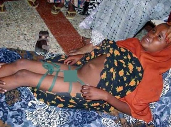 印尼女孩割礼后图片：女性割礼怎么回事图片(4)(点击浏览下一张趣图)