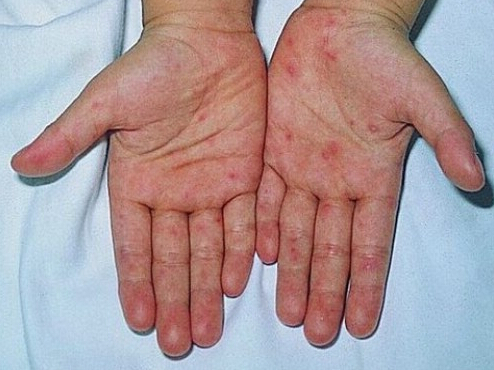 手足口病症状初期图片(点击浏览下一张趣图)