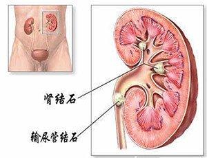 肾结石患者什么食物不能吃(2)(点击浏览下一张趣图)