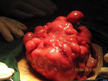 子宫肌瘤多大容易恶变，子宫肌瘤图片(点击浏览下一张趣图)