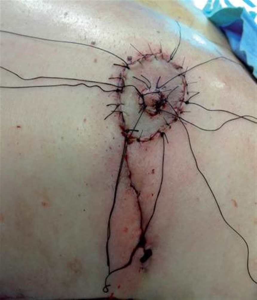 乳腺癌全切术后真人图片(点击浏览下一张趣图)