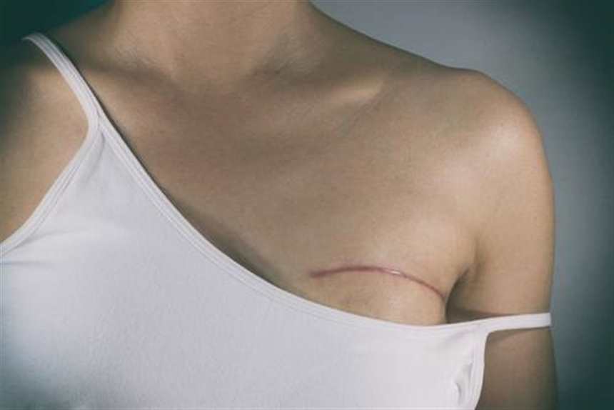乳腺癌全切术后真人图片(2)(点击浏览下一张趣图)