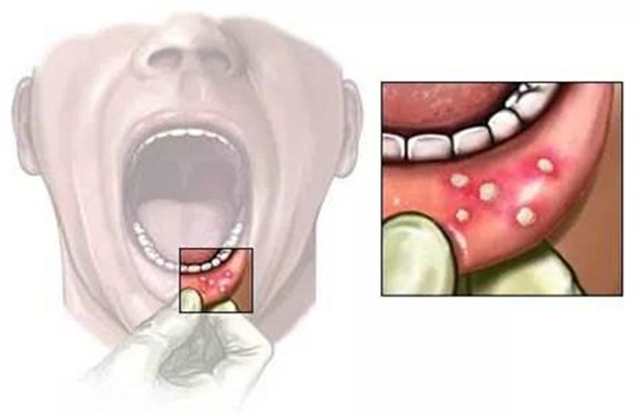 口腔溃疡反复发作是什么原因呢(2)(点击浏览下一张趣图)