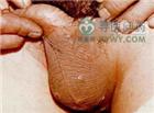女性阴囊湿疹图片