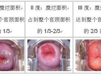 宫颈糜烂图片1至3度图片，标准对照图片2022