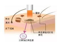 烟酰胺是什么？能祛斑吗？