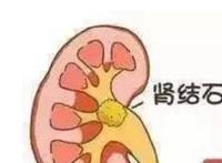 引起肾结石的4大罪魁祸首，怎样预防肾结石？