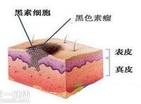 黑色素瘤早期症状图片 告诉你三大症状