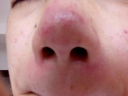 红鼻头的表现 有红鼻头要注意什么