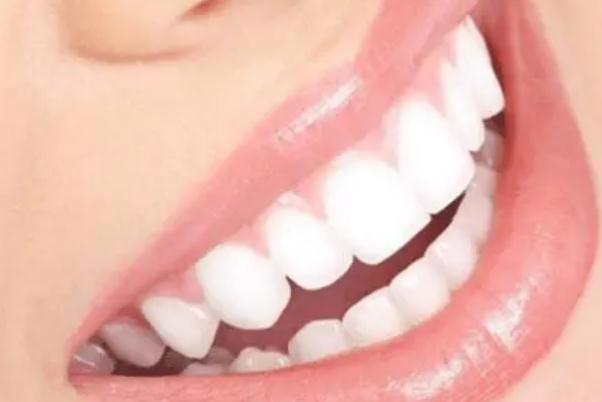 冷光美白牙齿是全口吗 什么是牙齿冷光美白