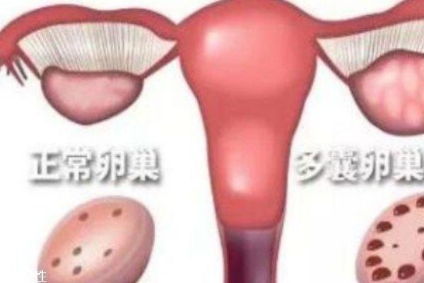 多囊卵巢综合症是什么 可以治愈吗