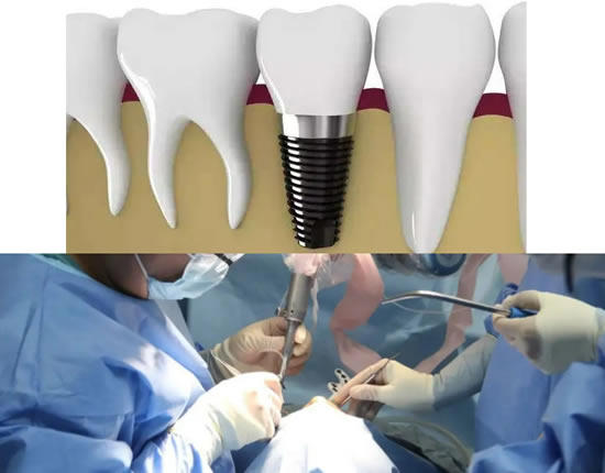 种植牙多少钱一颗2022价格表，最低种植牙5000元/颗