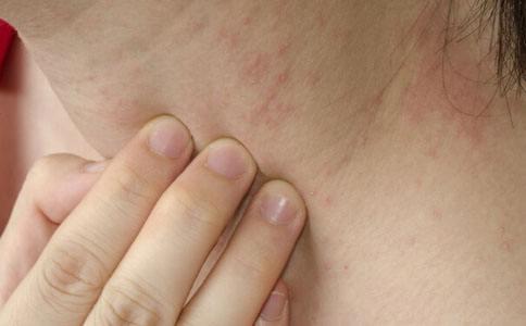 艾滋病一开始的皮肤图和初期症状，出现皮疹的皮肤呈红色
