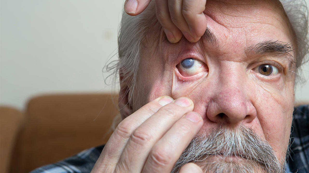 常见的五种眼病是什么？