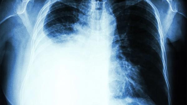 肺癌骨转移的症状有哪些