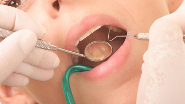 洗牙能去掉牙结石吗？