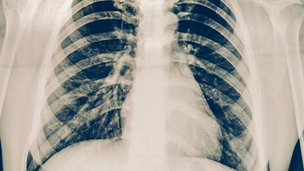 肺癌患者能活多久？