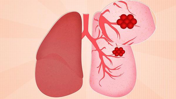 肺癌放疗期间吃什么？