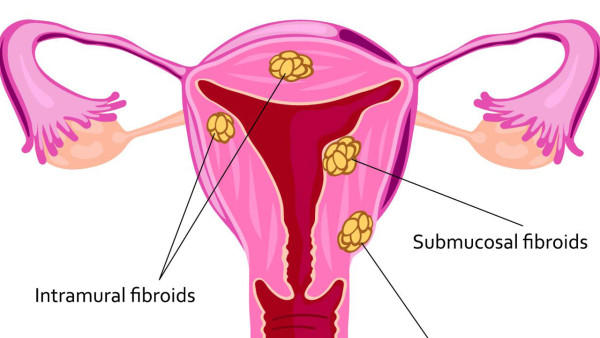 子宫颈癌前的筛查是什么？