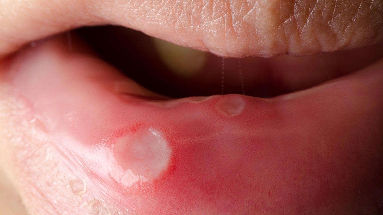 口腔癌该如何治疗？