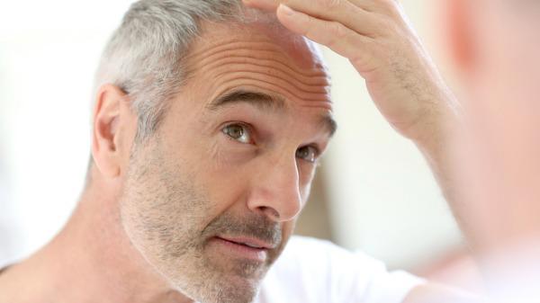 5个斑秃治疗最快的方法 斑秃可以自愈吗?