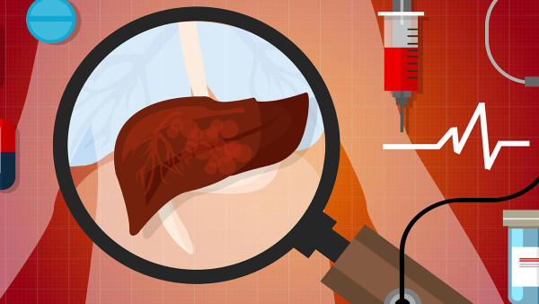 脂肪肝怎么治疗好的最快 揭秘脂肪肝的4大解决方法
