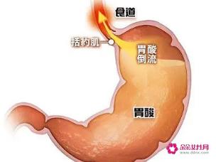 治胃酸的5个小妙招