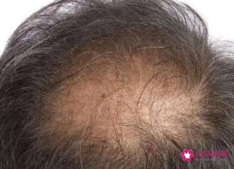 脱发患者有4种生发小偏方