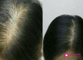 脱发患者有4种生发小偏方