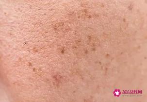 皮肤出现斑点是什么原因