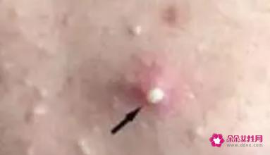 痘痘里面的白脓是什么