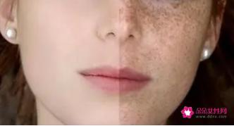 面部色斑是怎么形成的原因