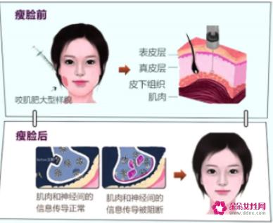瘦脸针有没有副作用呢