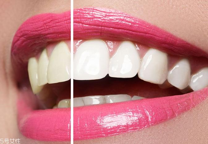 牙齿美白会伤害牙齿健康吗 牙齿美白过程会不舒服吗