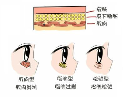 卧蚕和眼袋的区别图片 7招小技巧掩盖