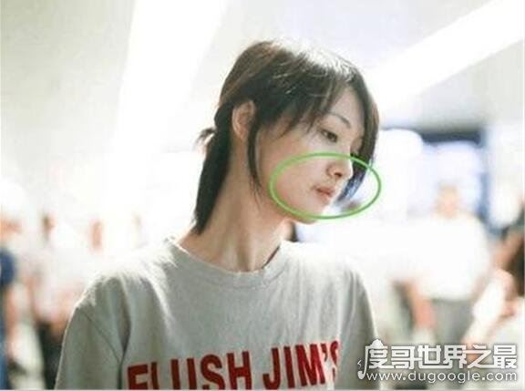 郑爽嘴角伤疤原因,因拍摄电视剧不小心被烫伤(并不是整容失败)
