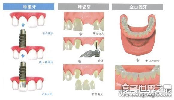 千万不要种植牙的5种情况，有这些情况的人种牙失败率会很高