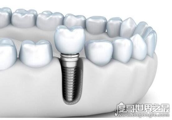 千万不要种植牙的5种情况，有这些情况的人种牙失败率会很高