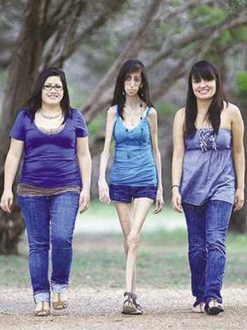 世界上超级瘦的人图片，最瘦的女人40斤/最瘦的男人80斤