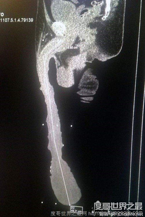 世界最长的阴茎，54岁男子阴茎长48厘米