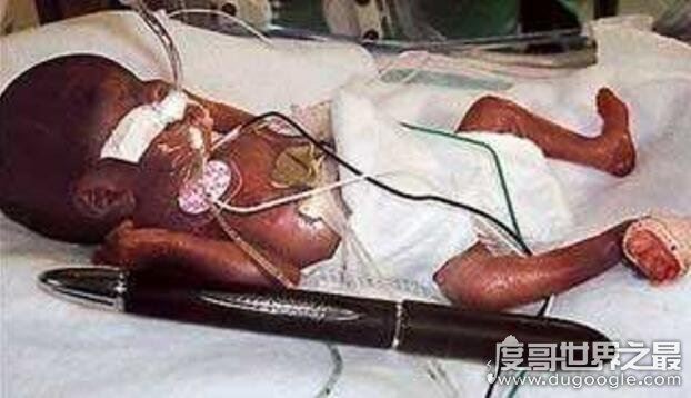 世界上最小的婴儿，阿米莉亚出生仅25cm重280克