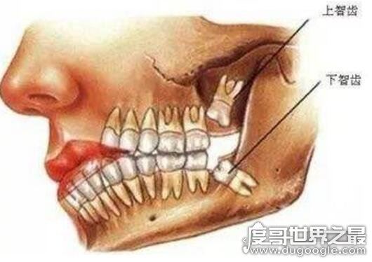 不需要拔的智齿图片，这4种情况下的智齿其实并不需要拔