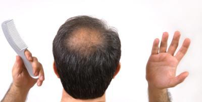 遗传性脱发可以治疗吗？