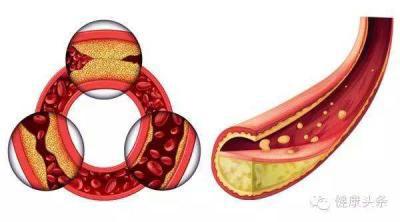血脂稠如何吃东西