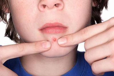 脸上的痘痘是由什么引起的？你知道吗？