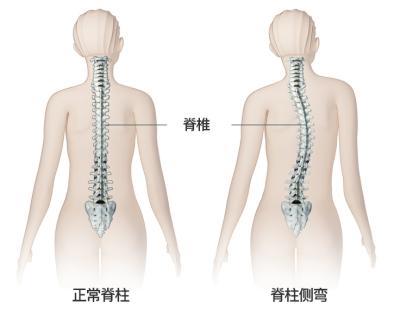 脊柱侧弯：症状，原因和治疗