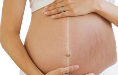 关于妊娠纹的9件事