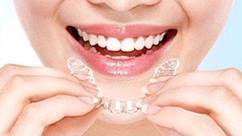 关于牙套/牙齿矫正的5个事实